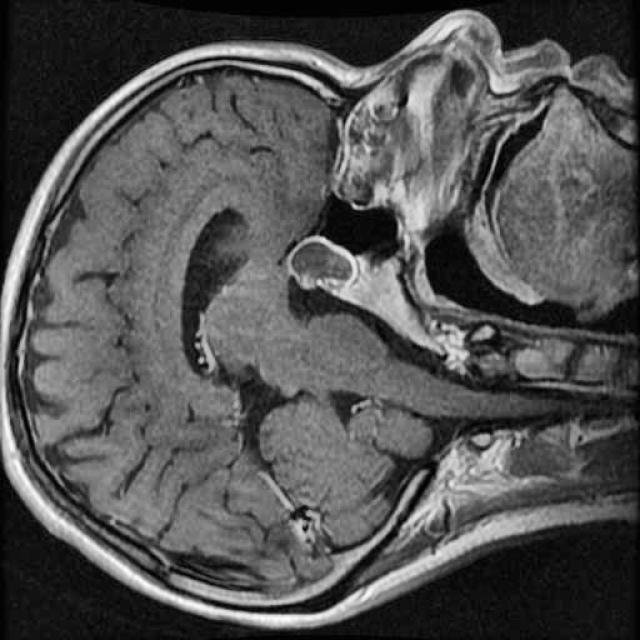 Brain MRI sample 2