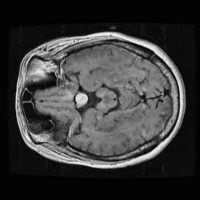 Brain MRI sample 3